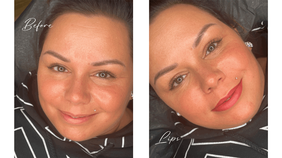 Vorher/Nachher Lippen